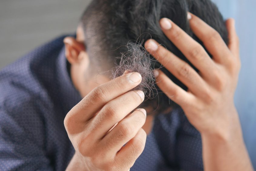 Hoe werkt het proces van een haartransplantatie van A tot Z?